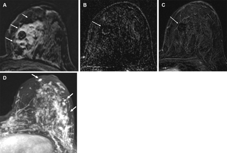 Triple-negative metaplastic carcinoma of the left breast in a 38-year-old woman. (A) Axial postcontrast T1-weighted MR image shows the malignancy as an 8-cm area of nonmass enhancement with regional distribution (arrows). (B) Axial postcontrast T1-weighted subtraction MR image in the early phase after NAC shows no residual enhancement. A biopsy clip–related susceptibility artifact (arrow) is noted. (C) Axial postcontrast T1-weighted subtraction MR image in the late phase after NAC shows no residual enhancement, with the biopsy clip–related susceptibility artifact (arrow) still seen. The patient underwent surgery, which revealed a 1-mm focus of residual carcinoma. (D) Maximum intensity projection breast MR image 1 year after the completion of segmental mastectomy and radiation therapy shows numerous areas of nonmass enhancement and multiple foci suggestive of recurrence involving four quadrants (arrows). US-guided biopsy confirmed the recurrence.