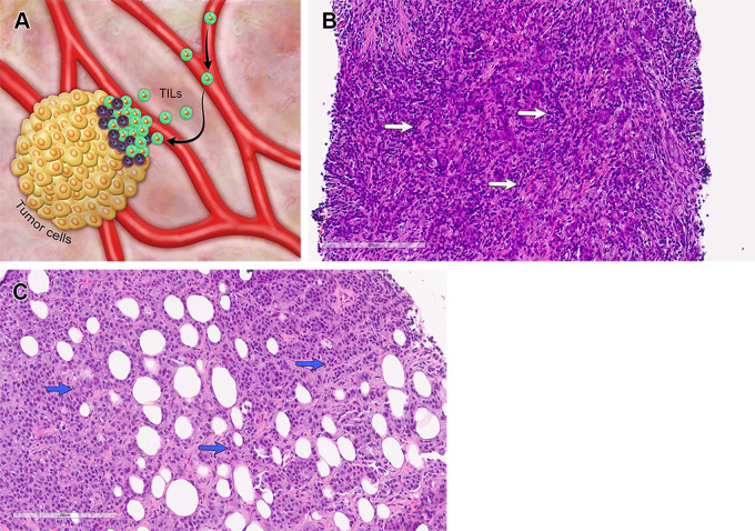 TILs in TNBC. Normal breast tissue does not contain large aggregates of immune cells. (A) As cancer grows, lymphocytes recognize the cancer cells as abnormal and infiltrate the tumor. TILs are mononucleated lymphoid cells that infiltrate the tumor and its stroma and reflect the host immune response against the tumor cells. Quantification of TILs is performed on hematoxylin-eosin (H-E)–stained tissue sections from biopsy specimens obtained at the time of diagnosis and in the residual disease after NAC. Only those TILs located in the stromal portions between cancer cells are considered when counting. (B, C) Photomicrographs show two cases of TNBC, one with high (B) and one with low (C) levels of TILs. Arrows point to lymphocytes in the stroma associated with the invasive carcinoma. (H-E stain; original magnification, ×400.)