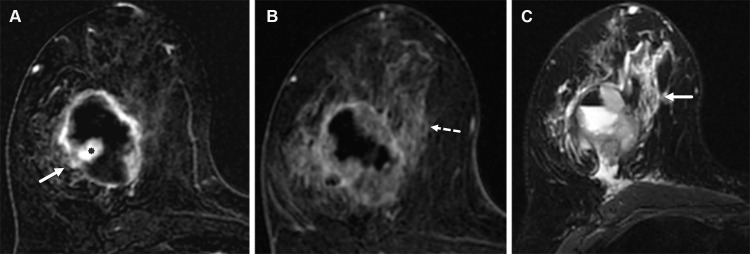 TNBC of the right breast in a 63-year-old woman. (A) Axial postcontrast T1-weighted subtraction MR image shows a 5-cm complex cystic and solid enhancing mass (*) with thick irregular rim enhancement (arrow). (B) Axial late phase postcontrast T1-weighted subtraction MR image shows associated nonmass enhancement (arrow). (C) Axial T2-weighted MR image shows peritumoral edema (arrow). MRI-guided biopsy of the area of nonmass enhancement (not shown) showed reactive changes and lymphocytic perilobulitis, indicating that the nonmass enhancement represented peritumoral edema.