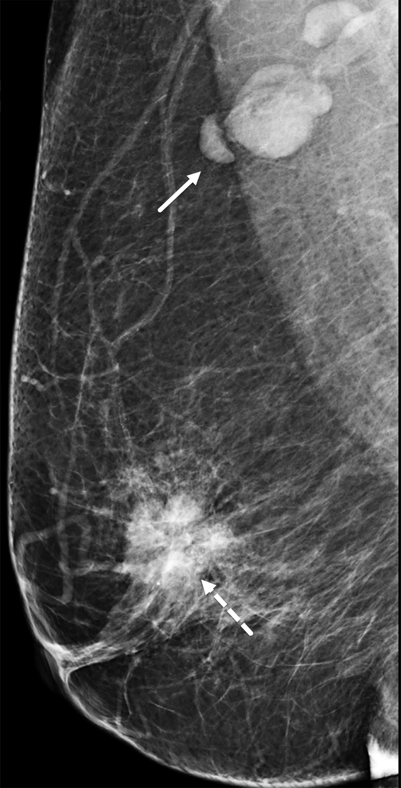 TNBC of the right breast in a 74-year-old woman. Right mediolateral oblique mammogram shows a 3-cm irregular noncalcified mass (dashed arrow) with spiculated margins and a 2.5-cm enlarged axillary lymph node (solid arrow).