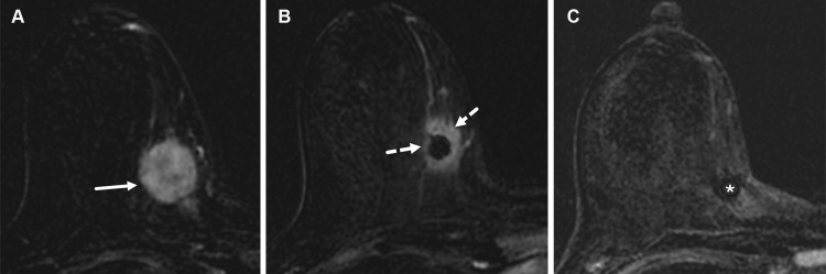 Triple-negative invasive ductal carcinoma of the right breast in a 40-year-old woman. (A) Axial postcontrast T1-weighted subtraction pretreatment MR image shows a 3-cm round mass (arrow) with homogeneous enhancement in the upper inner quadrant. (B) Axial postcontrast T1-weighted subtraction midtreatment MR image shows a 1-cm mass (arrows) with a pattern of concentric shrinkage. The central area with a signal void is related to susceptibility artifact from a biopsy clip. (C) Axial postcontrast T1-weighted subtraction posttreatment MR image shows a biopsy clip susceptibility artifact (*) but no evidence of enhancement, indicating complete resolution of the mass. The imaging findings are consistent with a complete imaging response. Final pathologic analysis revealed no residual carcinoma in the breast.