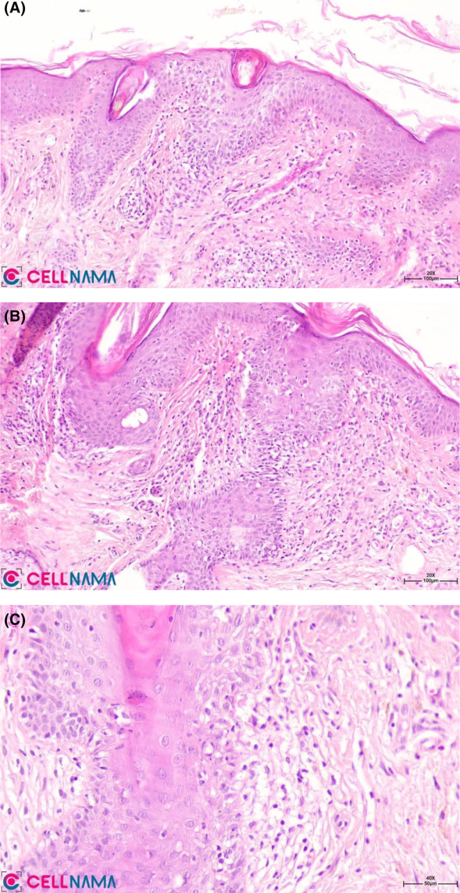 Coexistent frontal fibrosing alopecia with ophiasis pattern alopecia ...