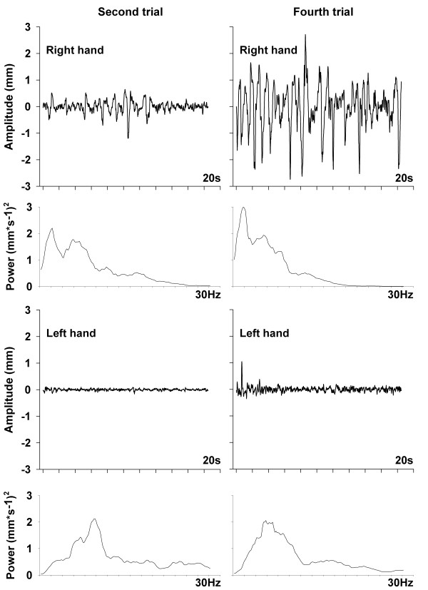 Changes in physiological tremor associated with an epileptic seizure: a ...