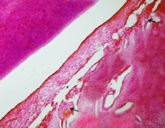 Figure 4: Experimental group - [Magnification x100,
Hematoxylin and Eosin stain] illustration of reduced osteoclasts
(arrow) in the mesial alveolar bony portion of the mandibular
molar in Experimental group.