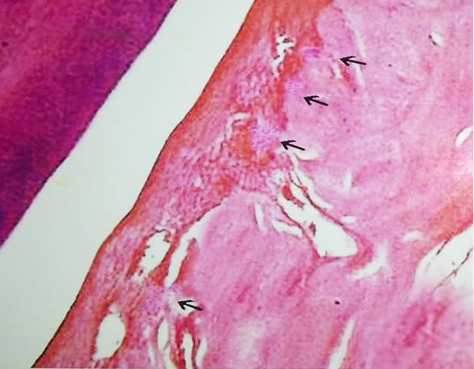 Figure 3: Control group - [Magnification x100, Hematoxylin
and Eosin stain] illustration of multiple osteoclasts (arrow) in
the mesial alveolar bony portion of the mandibular molar in
Control group.