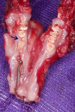 Figure 2: Dissected mandible with appliance, diastema is
visible in between 1st and 2nd molar.