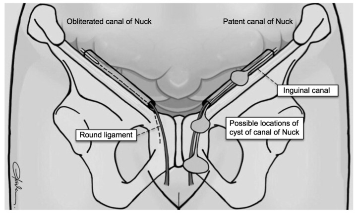 Cyst Of The Canal Of Nuck In Adult Females A Case Report And