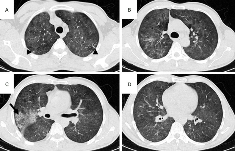 Pulmonary invasive fungal disease and bacterial pneumonia: a ...