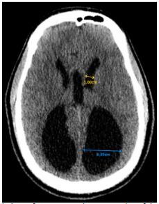 Colpocephaly Diagnosed in a Neurologically Normal Adult in the ...