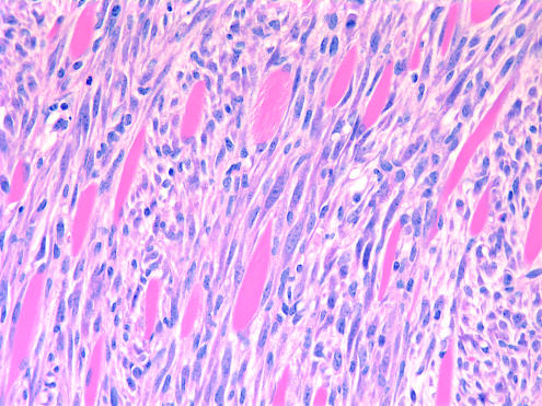 Squamous cell carcinoma invading muscle layer from ARF-null mouse