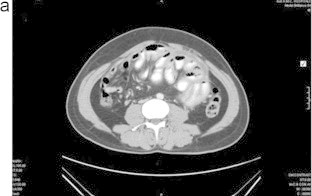 Abdominal cocoon—A rare cause of intestinal obstruction - PMC