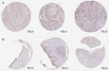 Figure 7. In the HPA database, DHCR24 is highly expressed in the immunohistochemical sections of bladder cancer. Immunohistochemical images of (A) cancerous bladder tissue from patients with bladder c...