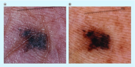 Improving the diagnosis and treatment of acral melanocytic lesions - PMC