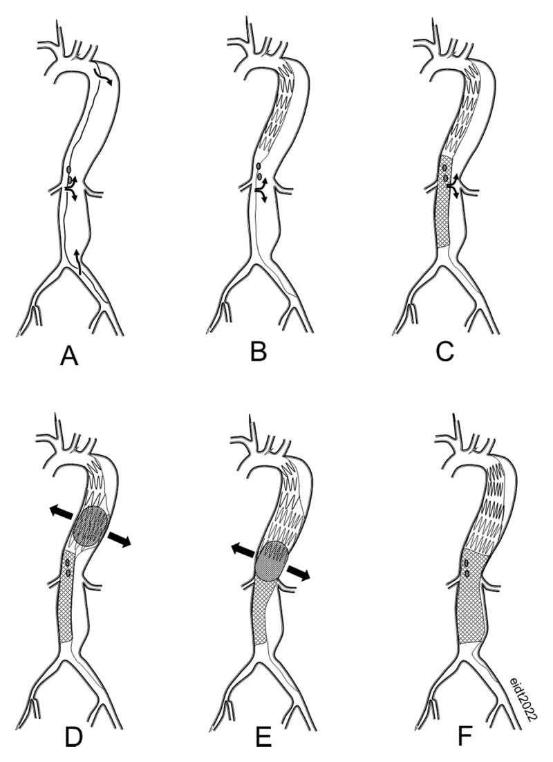 (A) Acute type B aortic dissection Following endograft