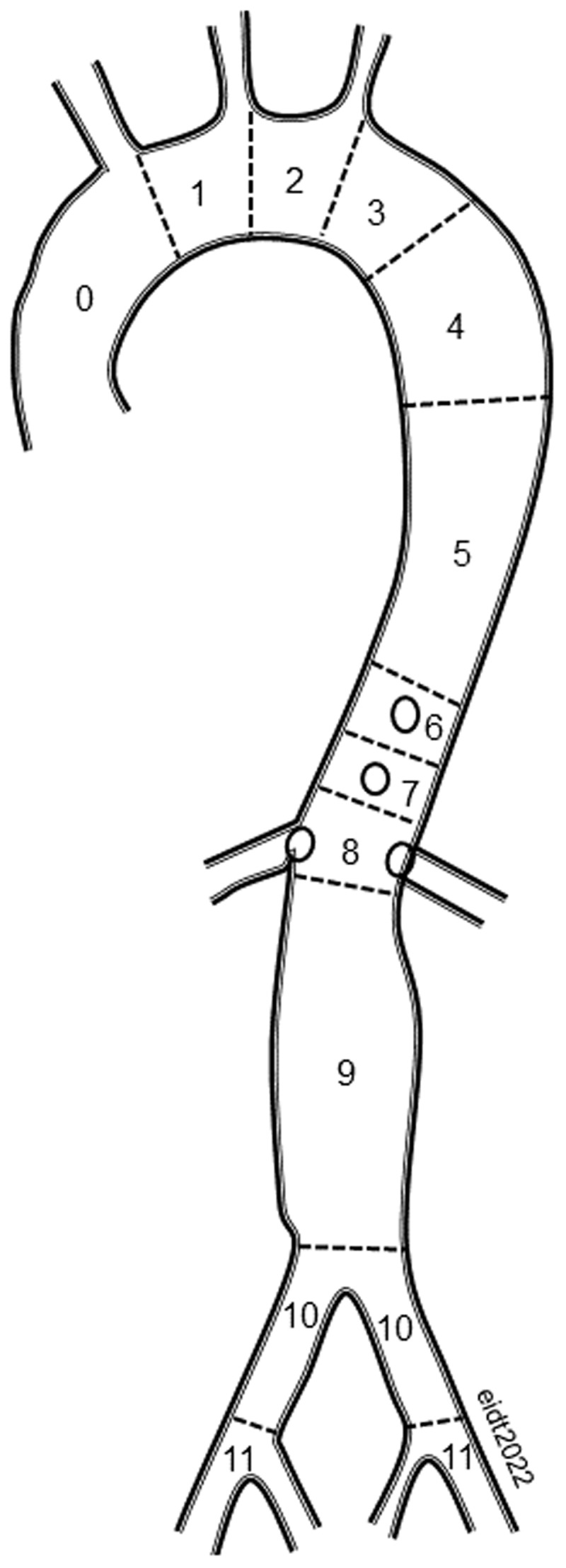 11 zones starting at the aortic valve and extending into the external iliac arteries