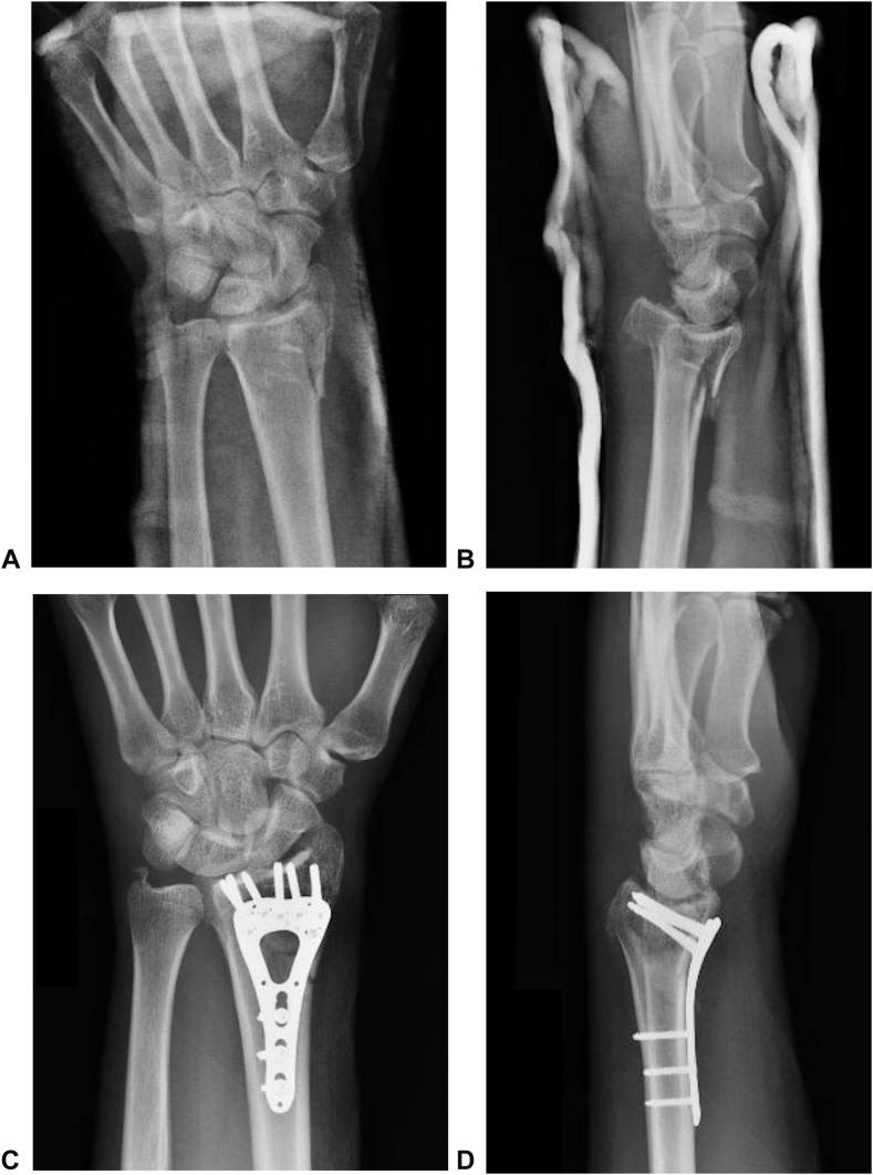 The Extended Flexor Carpi Radialis Approach for Distal Radius Fracture ...