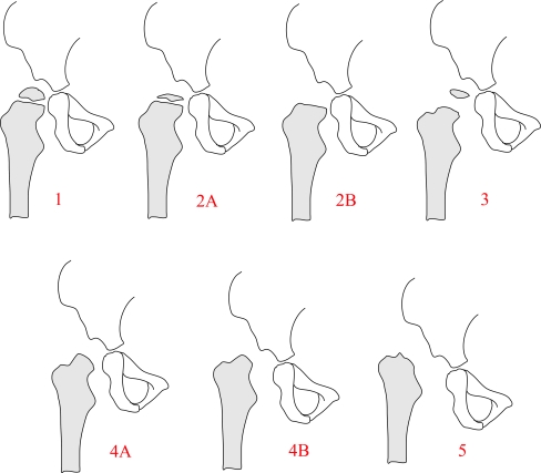 The pelvic support osteotomy: indications and preoperative planning - PMC