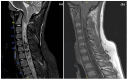 A medical image of a cervical spine showing a syrinx and tonsillar descent.