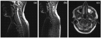 The image shows preoperative MRI scans of a brain and spine. Sagittal T2 images of the upper spine highlight crowding at the cervicomedullary junction with C2 multiloculations and an expansile hydrosyringomyelia. The associated longitudinal hydrosyringomyelia extends from the craniocervical junction to the T9 to T10 level, with internal septations at the C2 level.