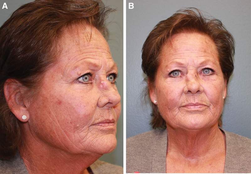 Calcinosis cutis of the nasal dorsum pmc