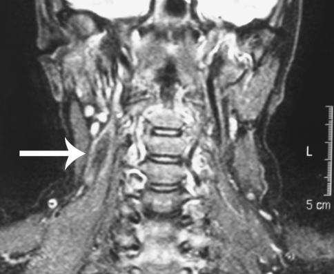 Collagenous Fibroma (Desmoplastic Fibroblastoma) of the Neck Presenting ...