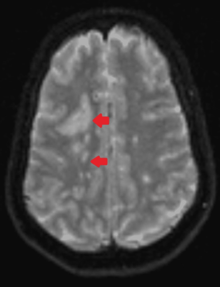 A Common Neurological Presentation With An Unusual Etiology Dense Hemiplegia Due To