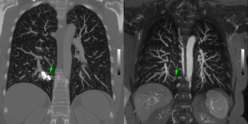 Coronal CT angiogram (left) in a 50-year-old woman with hereditary hemorrhagic telangectasia, who underwent prior coil embolization of a pulmonary arteriovenous malformation in the medial right lower lobe. Beam-hardening artifact related to the metallic coils (arrow in left panel) obscures the presence of recanalization that is demonstrated by the MR angiogram with ferumoxytol (arrow in right panel) and is void of beam-hardening artifact.