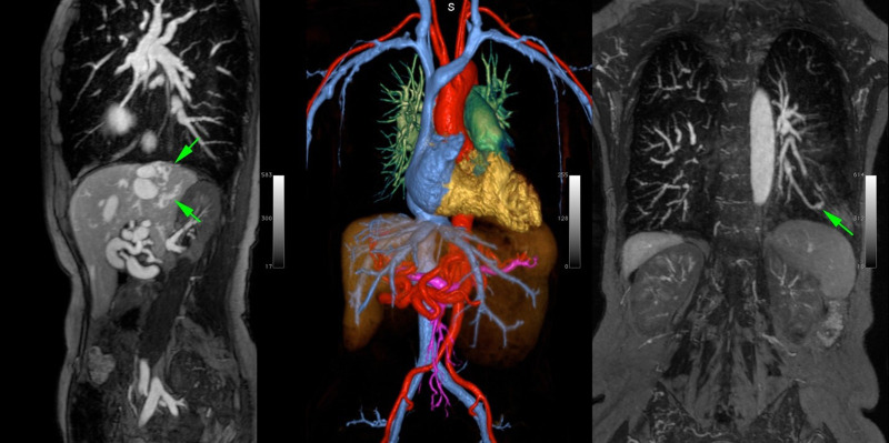 MR angiogram with ferumoxytol in a 58-year-old woman with hereditary hemorrhagic telangiectasia. Steady-state imaging in sagittal maximum intensity projection (MIP) view (left) demonstrates liver arteriovenous malformations (AVMs) (arrows). A pulmonary AVM is clearly visualized in the coronal MIP view in the right panel (arrow). Color three-dimensional volume rendering in the same patient (center) highlights the entire arterial and venous system and the presence of hepatic artery tortuosity and enlargement.