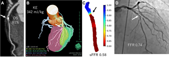 Images in a 73-year-old man with effort angina. (A) Coronary CT angiogram shows intermediate stenosis (arrows in A–D) at the mid left anterior descending (LAD) artery (61%). (B) The calculated kinetic energy (KE) was high (342 mJ/kg), and (C) simulated fractional flow reserve (sFFR) showed hemodynamically significant stenosis (sFFR, 0.58). (D) Invasive FFR showed pressure loss (FFR, 0.74). DS = diameter stenosis, LCX = left circumflex artery, RCA = right coronary artery.