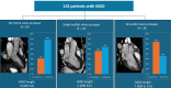 Bar graphs show the prevalence of arrhythmias in patients with MAD
according to the presence and pattern of MVP. MR images with the MVP are
marked in yellow, and the median length and IQR are shown for each type. MAD
= mitral annular disjunction, MVP = mitral valve prolapse.
