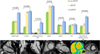 Bar graphs and corresponding MR images show the main cardiac MRI
findings in patients with MAD according to the presence and pattern of MVP.
bMVP = bileaflet mitral valve prolapse, ECV = extracellular volume, LAESVi =
indexed left atrium end systolic volume, LGE = late gadolinium enhancement,
LVEDVi = indexed left ventricle end diastolic volume, MAD = mitral annular
disjunction, MR = mitral regurgitation, MVP = mitral valve prolapse, sMVP =
single-leaflet mitral valve prolapse.