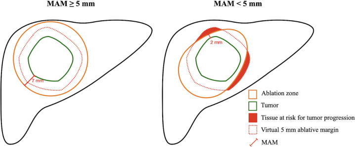 Schematic illustrations show minimal ablative margin (MAM) quantification. Left: The virtual 5-mm ablative margin (red dotted line) is completely covered by the ablation zone (orange solid line), with an MAM of 7 mm. Right: The virtual 5-mm ablative margin (red dotted line) is not completely covered by the ablation zone (orange solid line), with remaining tissue at risk for tumor progression (red) and an MAM of 2 mm.