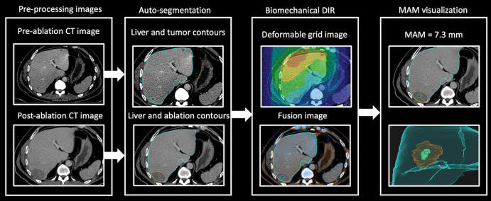 Flow diagram shows the steps in biomechanical deformable image registration (DIR) and minimal ablative margin (MAM) quantification in a 67-year-old man with solitary colorectal liver metastasis. Left: Pre- and postablation axial contrast-enhanced CT images with artificial intelligence–based autosegmentation show the liver, tumor, and ablation zone. Right: Biomechanical DIR is performed to register the pre- and postablation CT images. Then, the MAM is computed and visualized in images with two-dimensional and three-dimensional volume rendering.