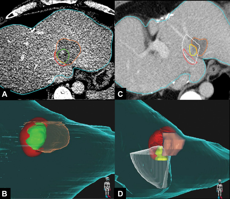 Images in a 41-year-old woman with colorectal liver metastasis who underwent CT-guided microwave ablation processed with the proposed biomechanical deformable image registration three-dimensional (3D) minimal ablative margin (MAM) quantification method. (A, B) Axial contrast-enhanced CT scan (A) obtained immediately after microwave ablation and corresponding 3D CT volume rendering (B) show autosegmentation of the tumor (green) and ablation zone (orange). Tissue at risk for tumor progression (red) is defined as the expanded tumor tissue not covered by the virtual 5-mm ablative margin. The MAM was determined to be 0 mm. (C, D) Axial contrast-enhanced CT scan (C) obtained 6 months after ablation and corresponding 3D CT volume rendering (D) show local tumor progression (yellow) and the corresponding radiating cone (white), which encompasses the tissue at risk for tumor progression (red), indicating that the site of local tumor progression is spatially correlated with the tissue at risk for tumor progression. The ablation zone (orange) has involuted compared with previous CT images.