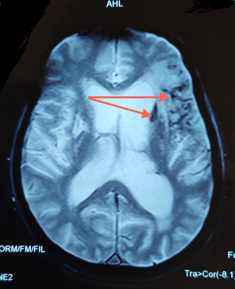 Axial Gradient Echo Image shows internal hypointense foci with blooming effect suggesting haemorrhage (red arrows)