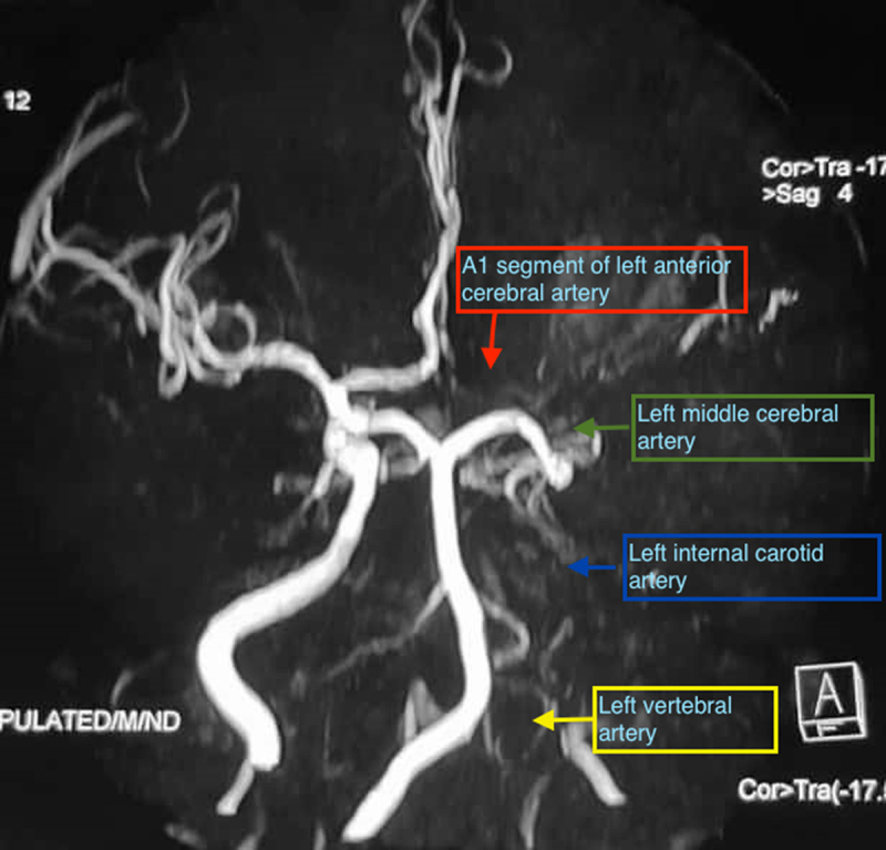 MR angiogram shows loss of flow signal in intracranial left internal carotid artery (blue arrow), left middle cerebral artery (green arrow)