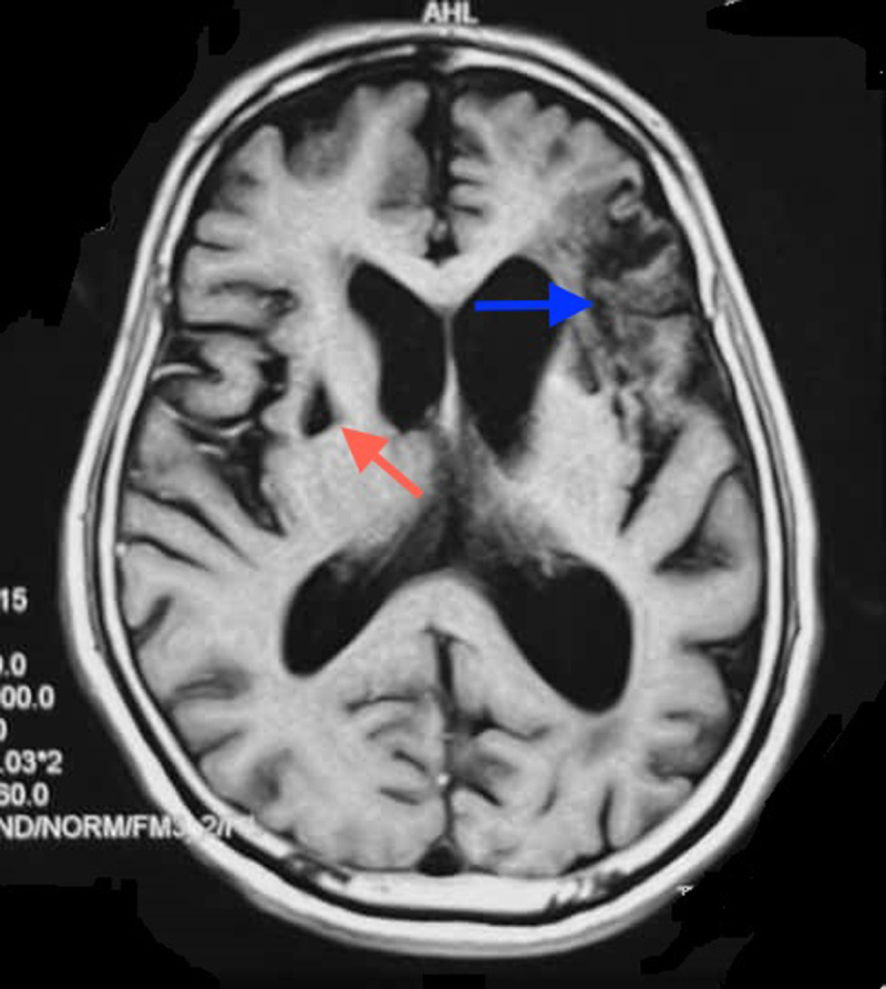 Axial T1 weighted MR image shows irregular signal characteristics in left lateral frontal cortex and white matter extending to operculum, precentral gyrus, sylvian cortex (blue arrow)