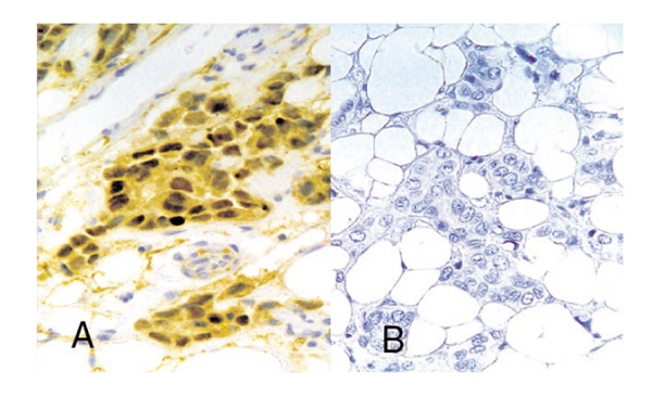 The pathology of familial breast cancer: Immunohistochemistry and ...