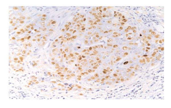 The pathology of familial breast cancer: Immunohistochemistry and ...