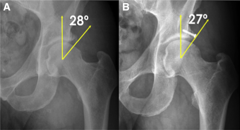 Arthroscopic Fixation of Os Acetabuli Technique: When to Resect and ...