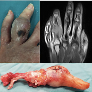 Figure 1. On the left side, it shows the swelling of the proximal phalanx of the fourth finger of the left hand on Sept 2019; on the right side, the MRI before surgery; below the surgical specimen of the fourth ray amputated.