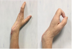 Figure 4. Three months postoperative check-up. The functionality of the gripper between the first and second fingers is good.