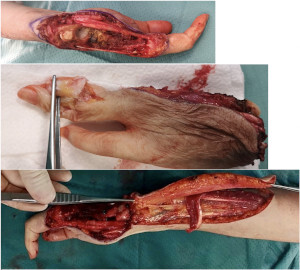 Figure 2. The third and fifth finger amputation includes carpal bones except for the scaphoid, trapezius, and trapezoid. The intermediate phalanx of the third finger was used to make an arthrodesis between the carpal bones and the second metacarpus. The gap reconstruction was performed with a fascial flap based on the dorsal ulnar artery.