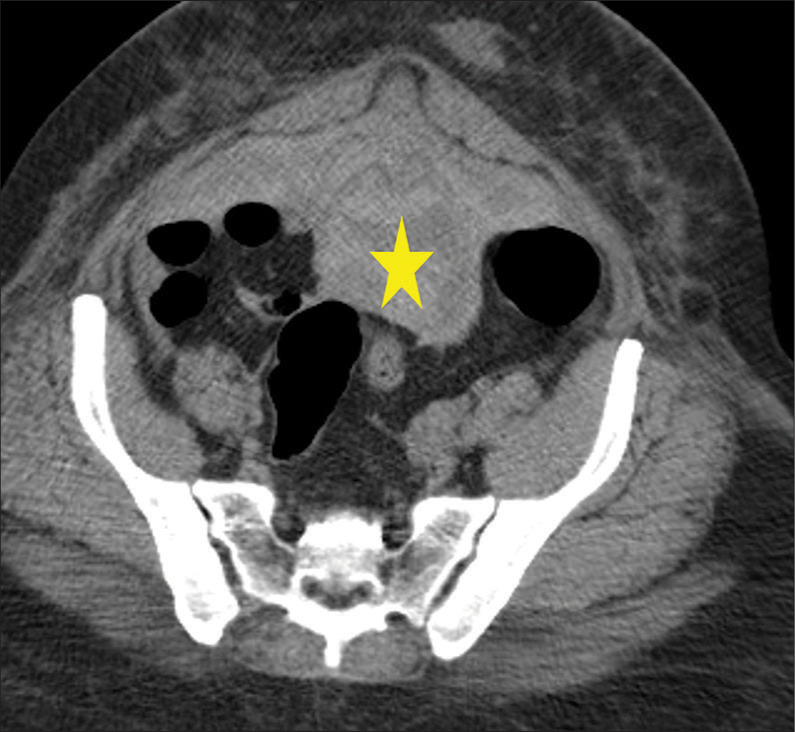 Intraperitoneal anatomy with the aid of pathologic fluid and gas: An ...