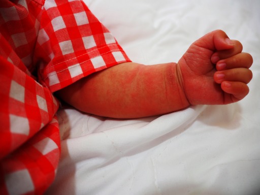 Photograph of a baby's arm covered with eczema