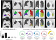 CO-RADS and CT severity score predictions for a COVID-19 negative case. 54-year-old man with negative RT-PCR test result. Non-contrast CT scan in coronal view (top row), overlaid with the automatic lobe segmentation (middle row) and the detected areas of abnormal parenchymal lung tissue (bottom row). This figure also shows the probabilities that the artificial intelligence model assigned to each CO-RADS category (bottom left), and the computed percentages of affected parenchymal tissue and the corresponding CT Severity Score (CTSS) per lobe (bottom right). The eight observers scored this case 3x CO-RADS 1, 3x CO-RADS 2, and 2x CO-RADS 3.