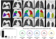 CO-RADS and CT severity score predictions for a COVID-19 positive case with little parenchymal involvement. 18-year-old man with positive RT-PCR test result. Non-contrast CT scan in coronal view (top row), overlaid with the automatic lobe segmentation (middle row) and the detected areas of abnormal parenchymal lung tissue (bottom row). This figure also shows the probabilities that the artificial intelligence model assigned to each CO-RADS category (bottom left), and the computed percentages of affected parenchymal tissue and the corresponding CT Severity Score (CTSS) per lobe (bottom right). The eight observers scored this case 2x CO-RADS 1, 5x CO-RADS 2 and 1x CO-RADS 3.