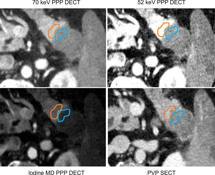 Axial dual-energy CT scan in a 63-year-old man with histopathologically proven pancreatic ductal adenocarcinoma in the tail of pancreas. Regions of interest were drawn on the normal pancreas adjacent to tumor border (orange) and the tumor periphery (blue) on the 70-keV PPP image (top left) and were simultaneously populated to identical locations on other image types. DECT = dual-energy CT, MD = material density, PPP = pancreatic parenchymal phase, PVP = portal venous phase, SECT = single-energy CT.