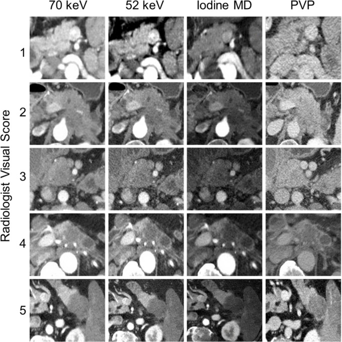 Qualitative assessment of border conspicuity. The figure demonstrates examples of tumors visually scaled from 1 to 5 on 70-keV, 52-keV, and iodine material density (MD) dual-energy CT images and conventional portal venous phase (PVP) images. Tumors scored as 4 or 5 were considered high delta, while tumors scored 1, 2, and 3 were considered low delta.