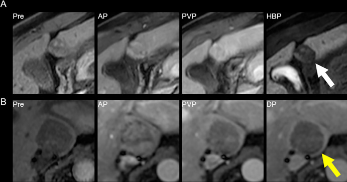 MRI scans show (A) reader disagreement and (B) reader agreement. (A) Gadoxetic acid–enhanced MRI scans in a 56-year-old male patient with cirrhosis secondary to hepatitis C. From left to right: contrast-unenhanced (Pre), arterial phase (AP), portal venous phase (PVP), and hepatobiliary phase (HBP) images. This 21-mm hepatobiliary phase hypointense observation (arrow) was characterized on the clinical read as having nonrim arterial phase hyperenhancement and washout appearance and was categorized as Liver Imaging Reporting and Data System (LI-RADS) category LR-5 (definitely hepatocellular carcinoma [HCC]). The first research reader characterized it as having a targetoid appearance and categorized it as LR-M (probably or definitely malignant, not specific for HCC). The second research reader characterized it as having no major features and paralleling the blood pool and categorized it as LR-2 (probably benign). It was subsequently resected and found to be a well-differentiated HCC. (B) Extracellular contrast–enhanced MRI scans in a 61-year-old female patient with cirrhosis secondary to hepatitis C. From left to right: contrast-unenhanced, arterial phase, portal venous phase, and delayed-phase (DP) images. This 31-mm observation (arrow) in the caudate lobe was characterized on the clinical read as having arterial phase hyperenhancement, washout appearance, and capsule appearance, and was categorized as LI-RADS category LR-5 (definitely HCC). Both research readers also categorized this observation as LR-5. The patient died of intracranial hemorrhage a few months later.